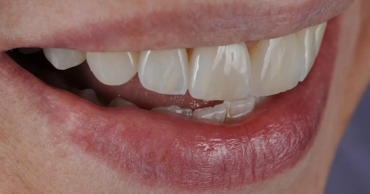Dettaglio di un sorriso con denti anteriori in vista laterale.