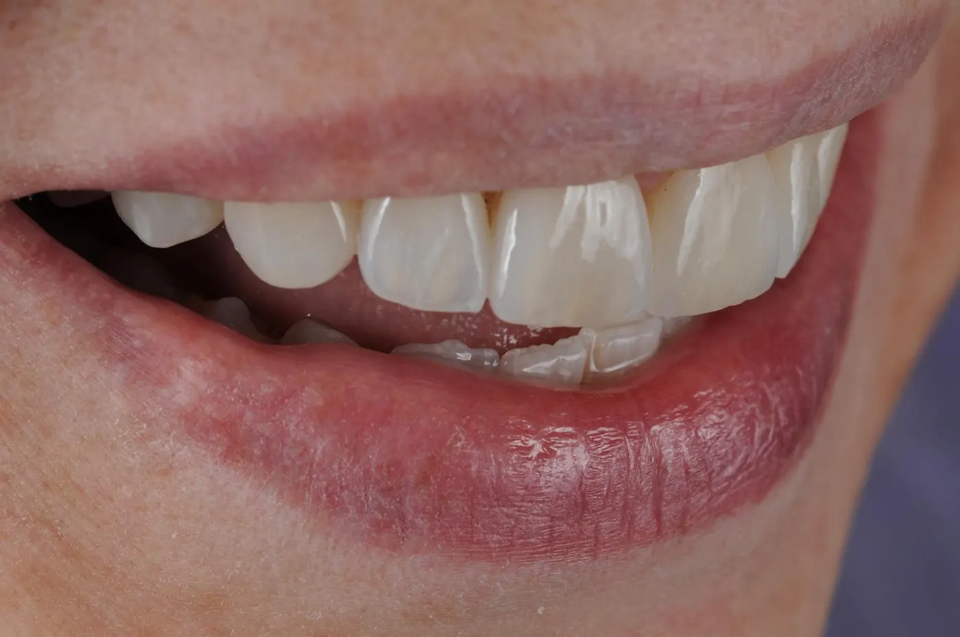 Sorriso dopo un trattamento di estetica dentale eseguito nello studio Dr. Paulov a Bra