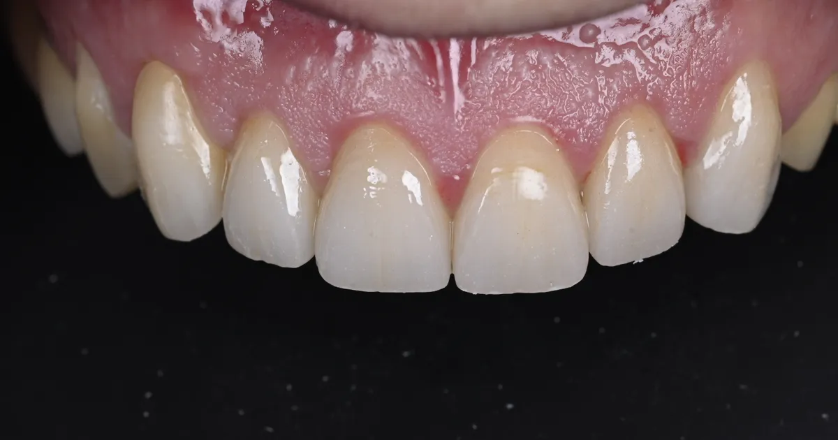Primo piano di un sorriso con denti chiari, fotografato in studio.
