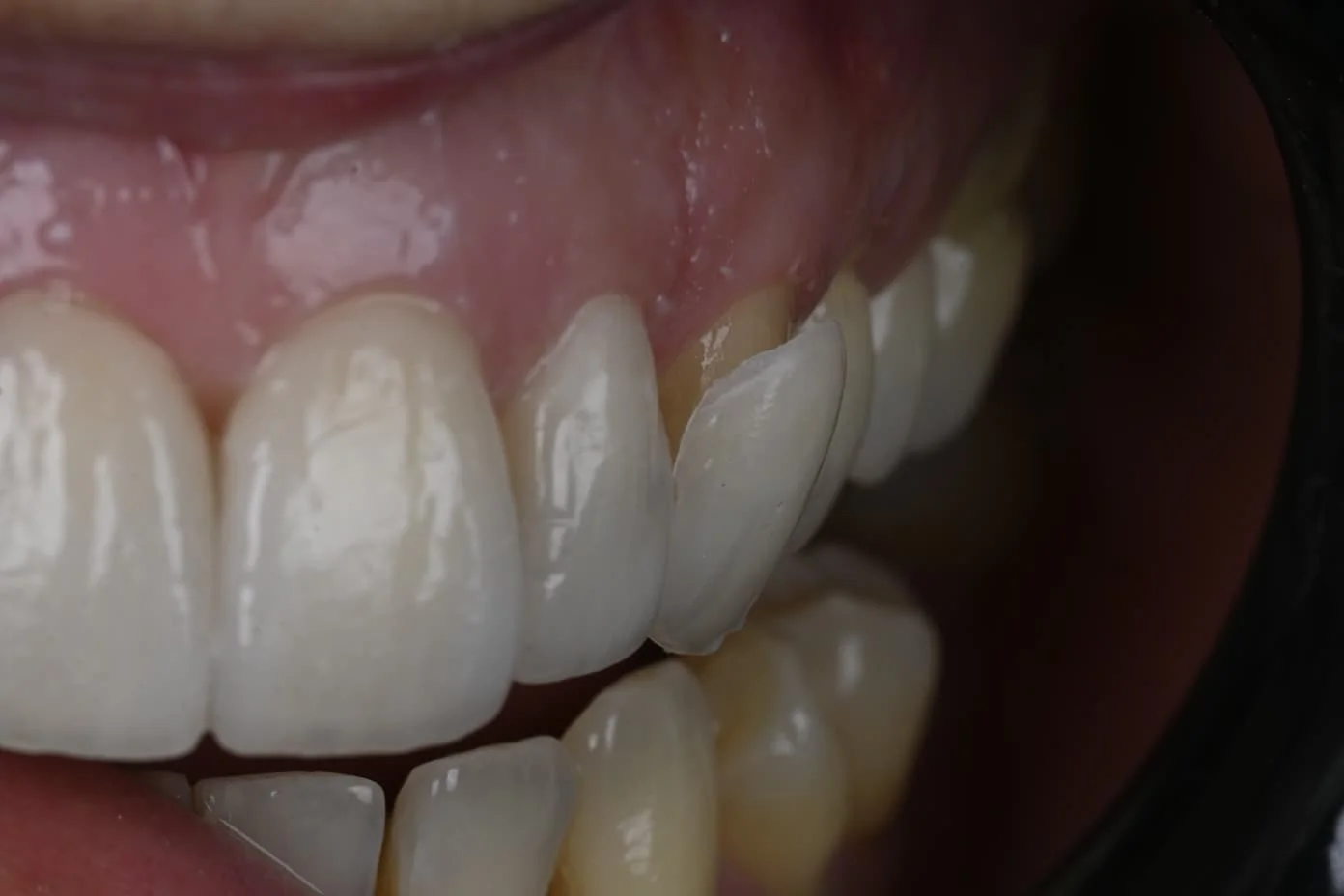 Faccetta in ceramica su dente laterale, dettaglio del risultato estetico