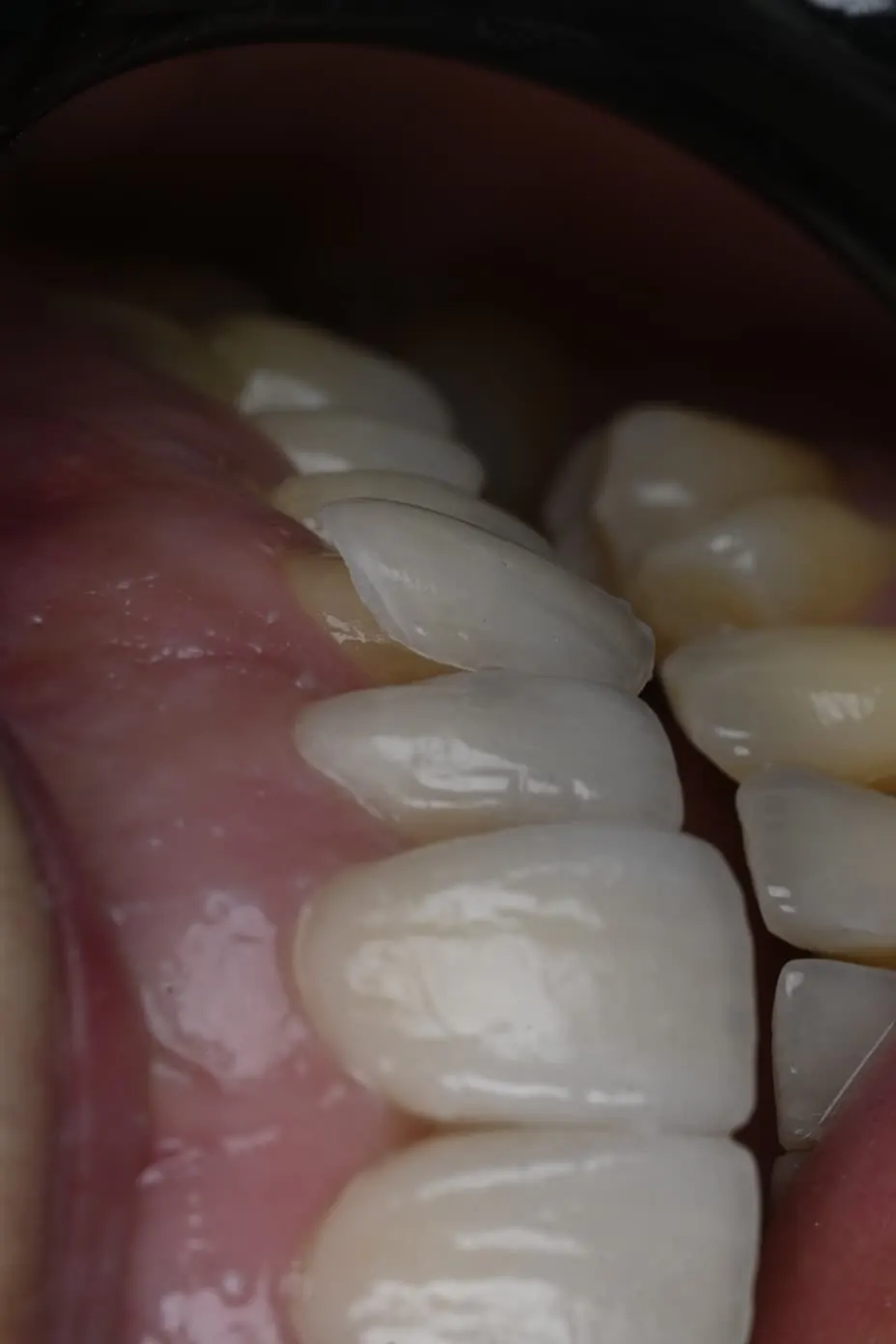 Dettaglio ravvicinato di una faccetta in ceramica su un dente anteriore, studio dentistico a Bra
