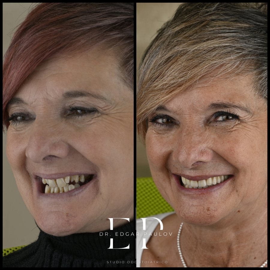 Sorriso della paziente prima del trattamento