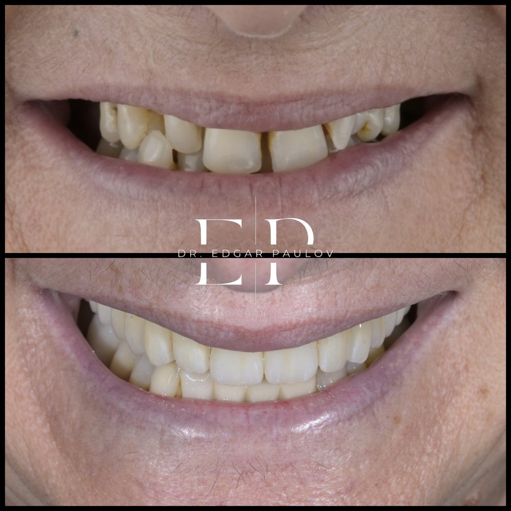 Denti posteriori prima e dopo le ricostruzioni