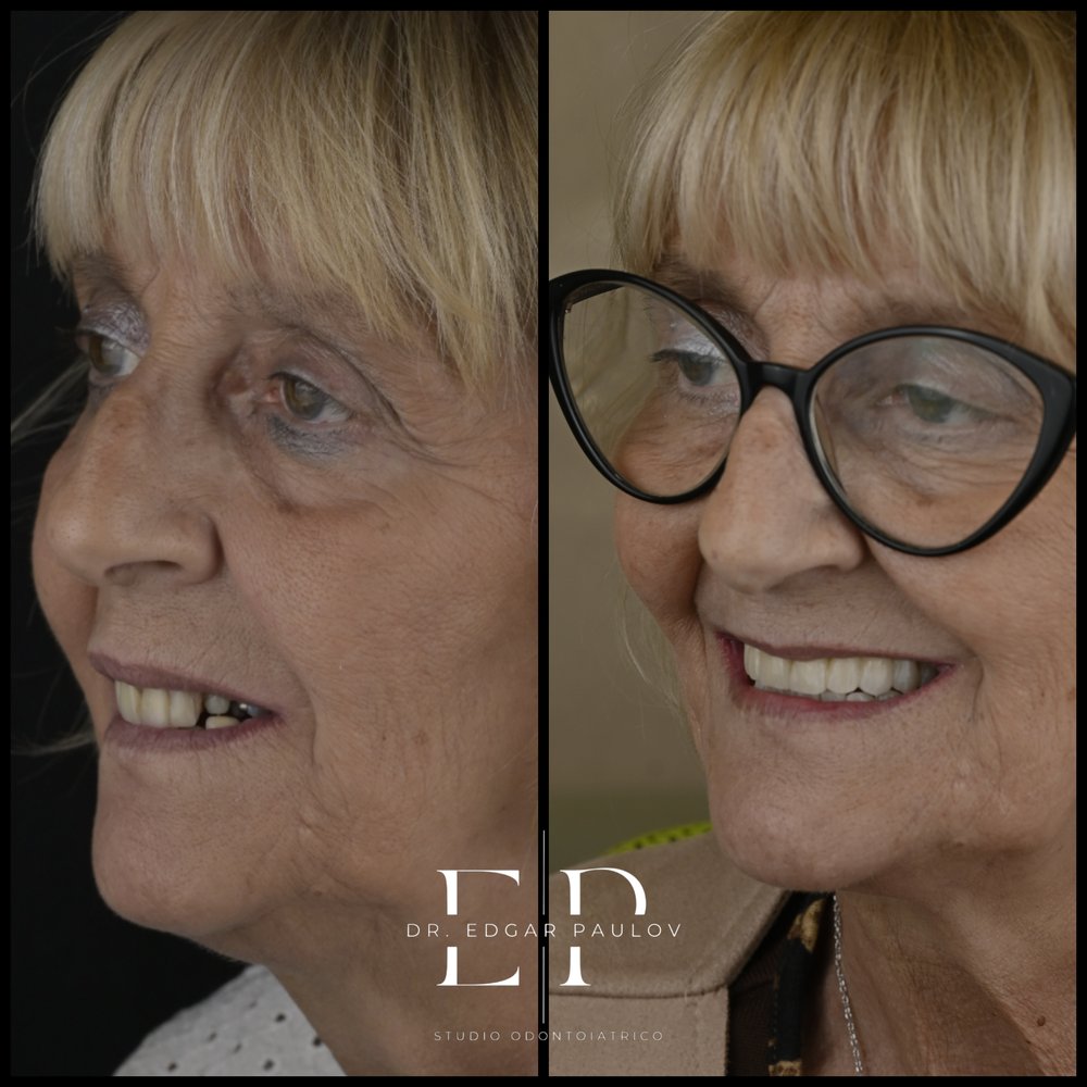 Paziente prima e dopo la riabilitazione del sorriso